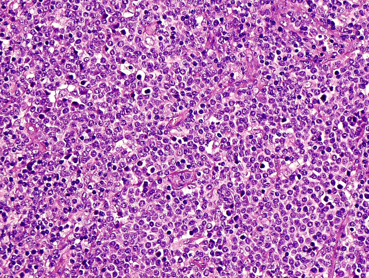 Fig 2: H&E x20 PDC nodule